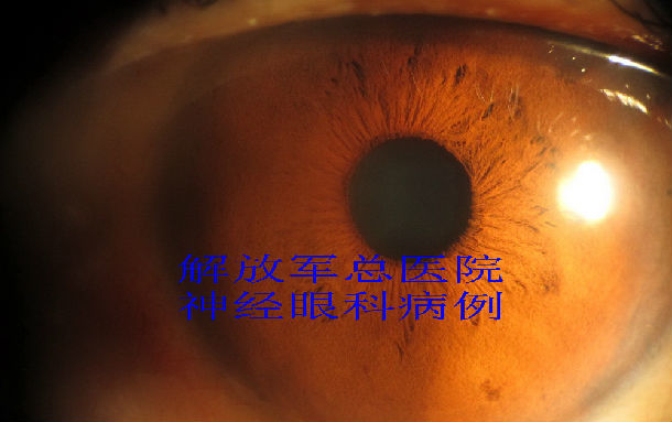 argyll roberston瞳孔,神经梅毒一例