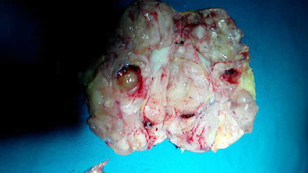 椎管内畸胎瘤图片