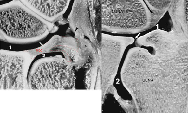 詳解tfcc的解剖