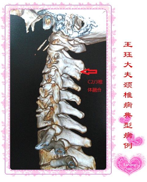 病例35:脊髓型颈椎病一期前后路联合手术