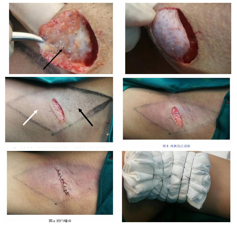 图解小切口翻转皮瓣直视下腋臭祛除术_腋臭_手术_日常护理_治疗方式