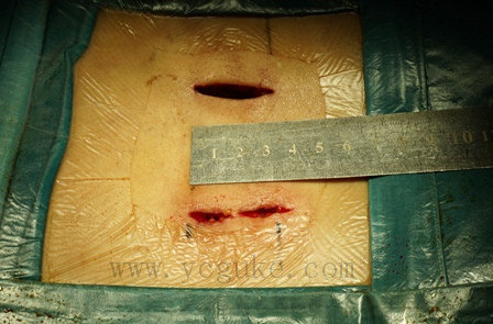 腰5骶1椎管狭窄微创手术病例(2014.11.28)