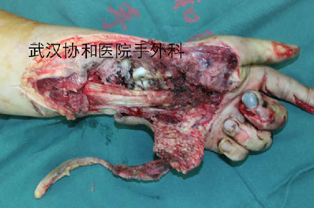 2014年10月20日完成的一例复杂烧伤的皮瓣转移手术