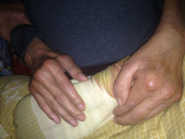 治疗不及时中风后肩手综合征第二期如治疗得当可不再进