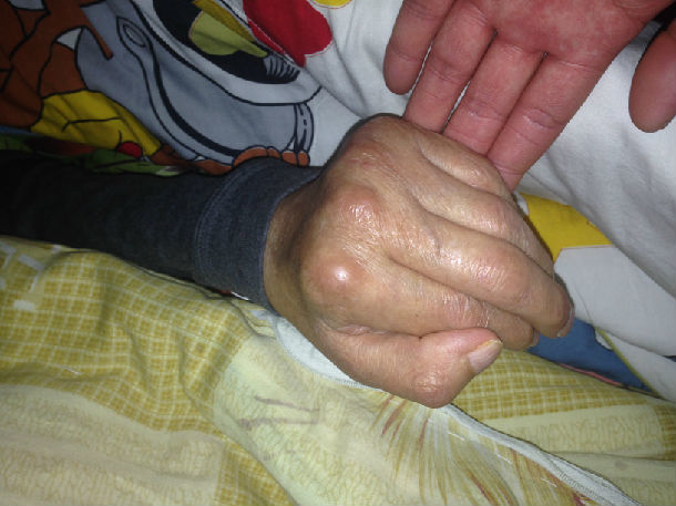 治疗不及时中风后肩手综合征第二期如治疗得当可不再进