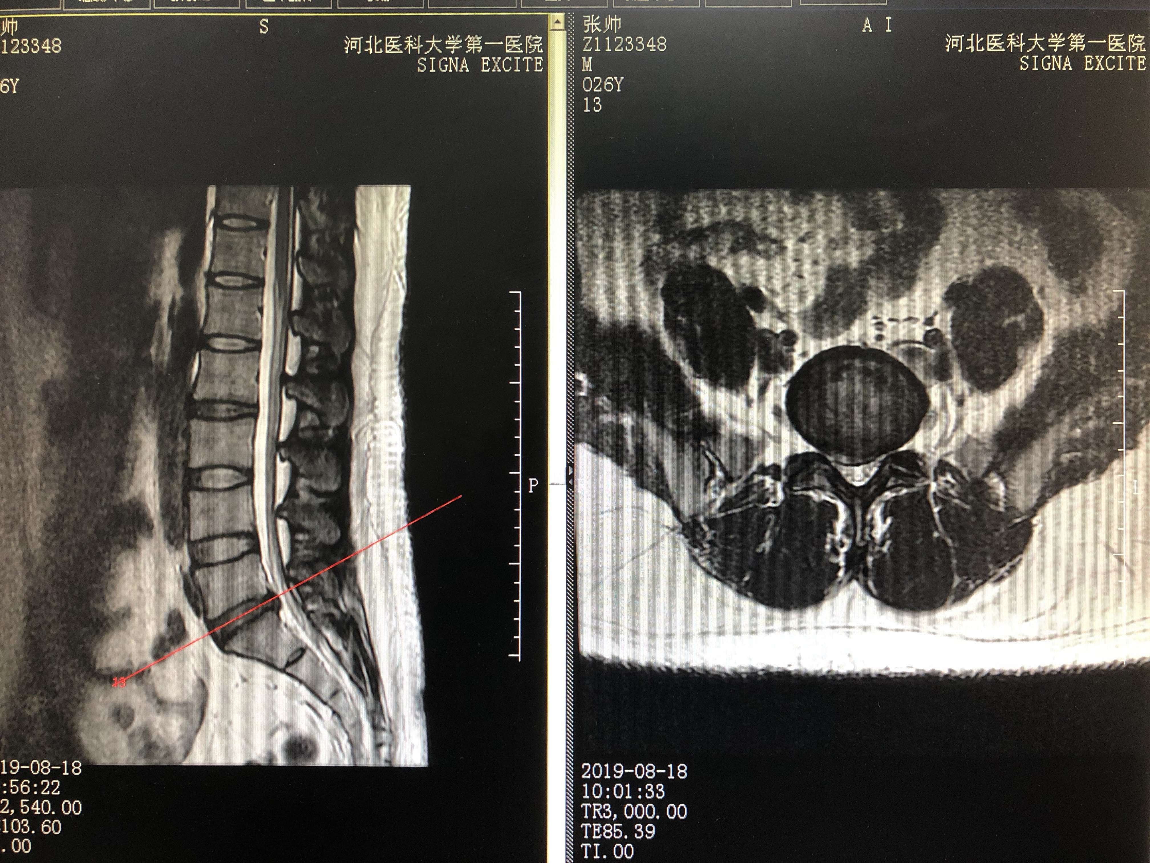 28岁女腰椎间盘突出图片