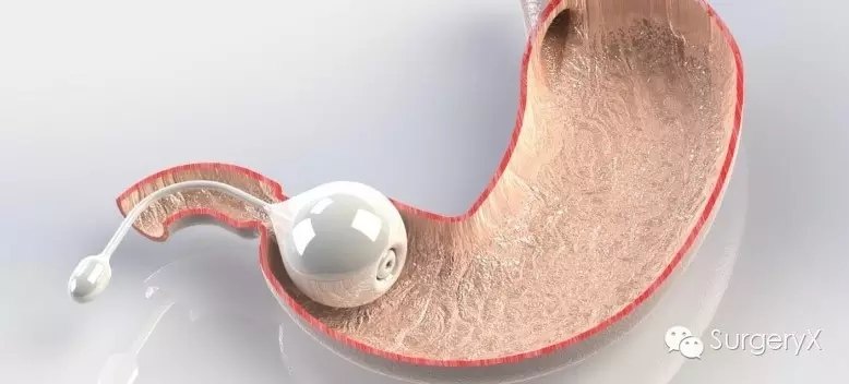 减肥新神器---人工胃幽门,刚获美国fda批准上市 - 好大夫在线