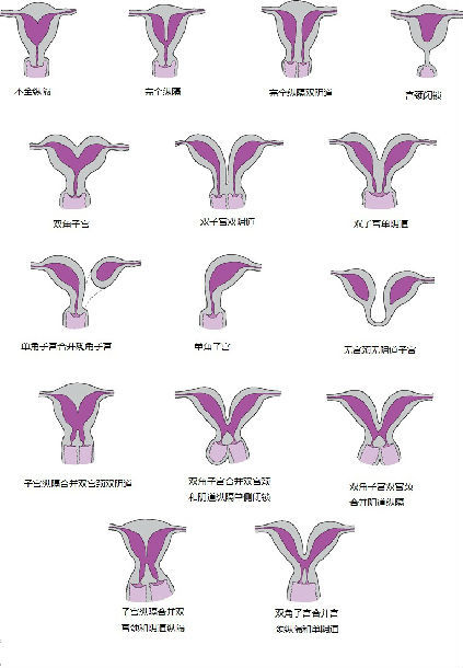 畸形子宫形态图片