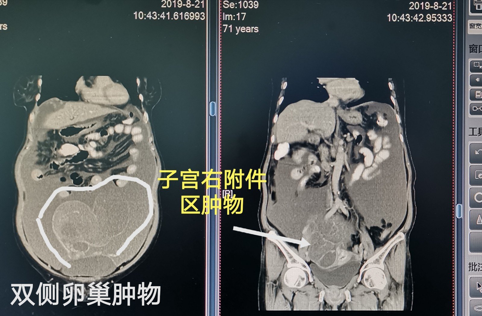 ct:腹盆腔大量積液,盆腔巨大腫物.