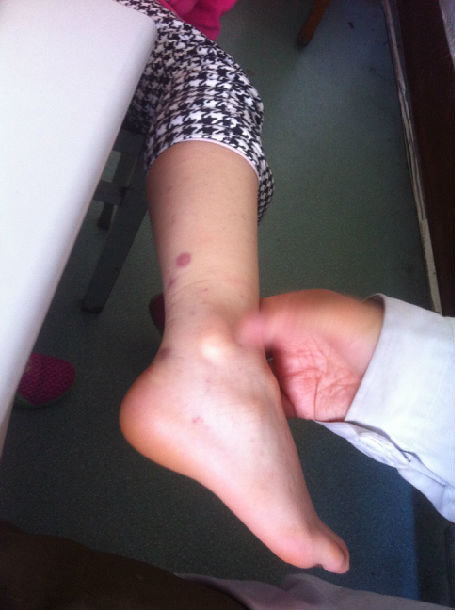 过敏性紫癜的临床症状及中医辨证治疗