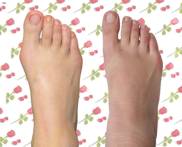 拇外翻手术效果 - 好大夫在线