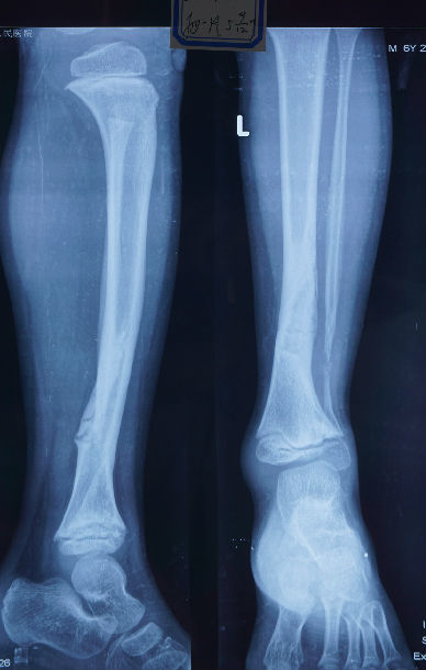 儿童先天性胫骨假关节保守治疗的长期随访-1例典型病例