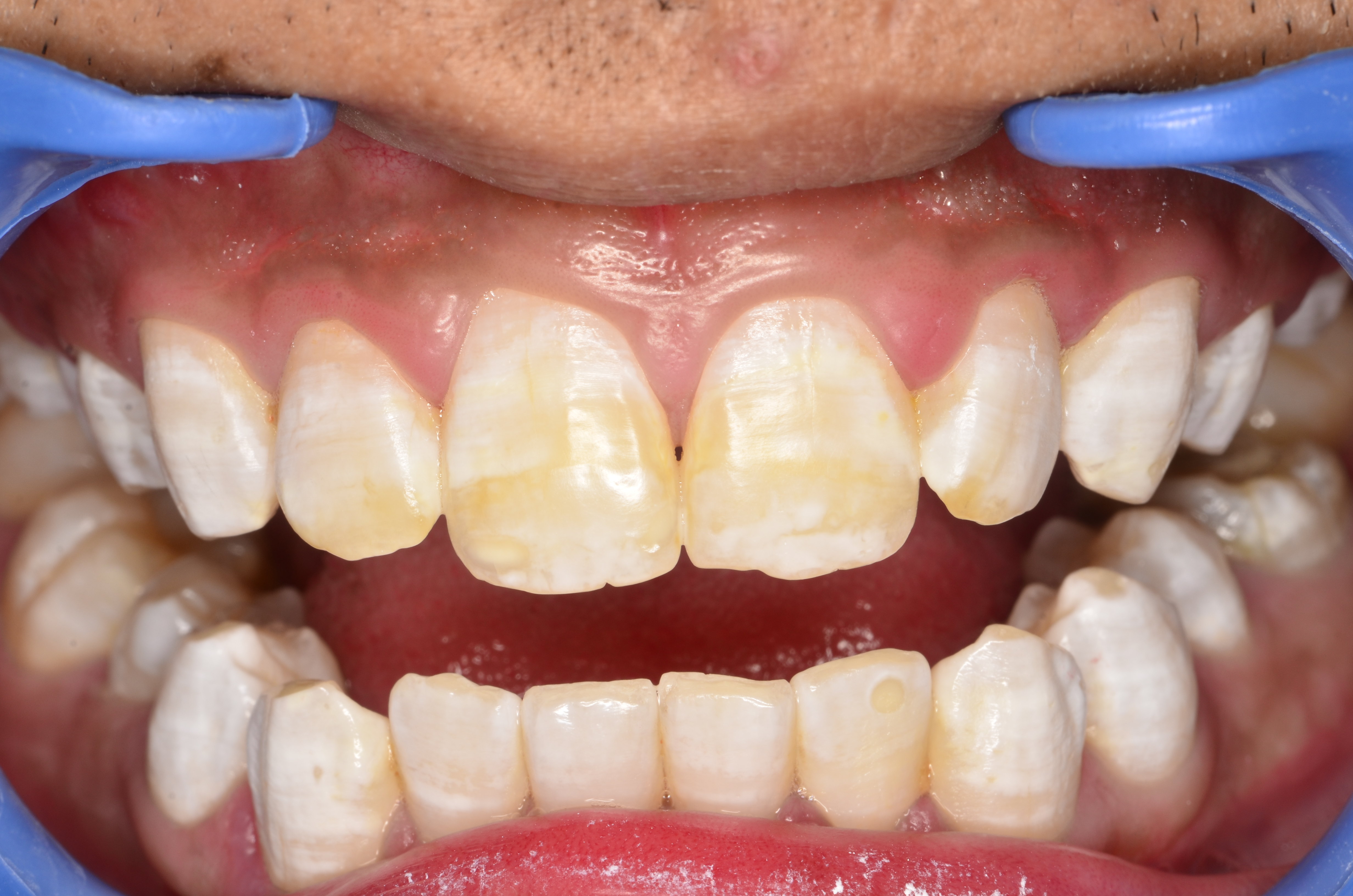 患者男,21岁患者自述:生活地区水质含氟量高,乳牙颜色基本正常,换牙后