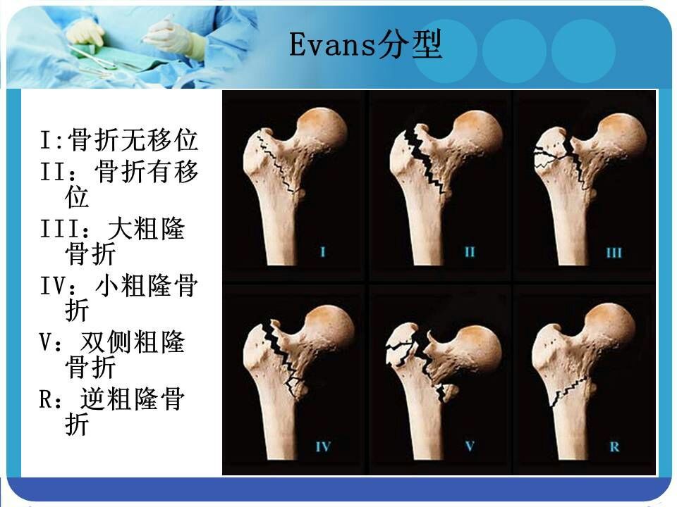 可以發現骨折,但在一些特殊的骨折類型中,如不完全性骨折,疲勞性骨折