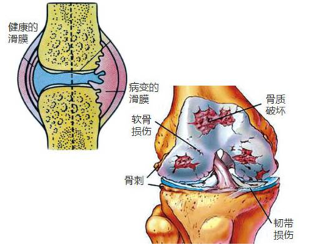 膝關節損傷_膝關節損傷疾病介紹 - 好大夫在線