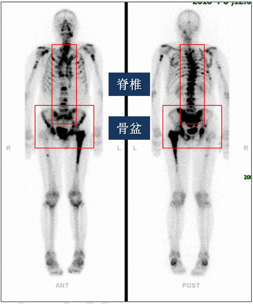 病例分享:"我想让你站起来",前列腺癌脊椎转移导致截瘫_前列腺癌_前列