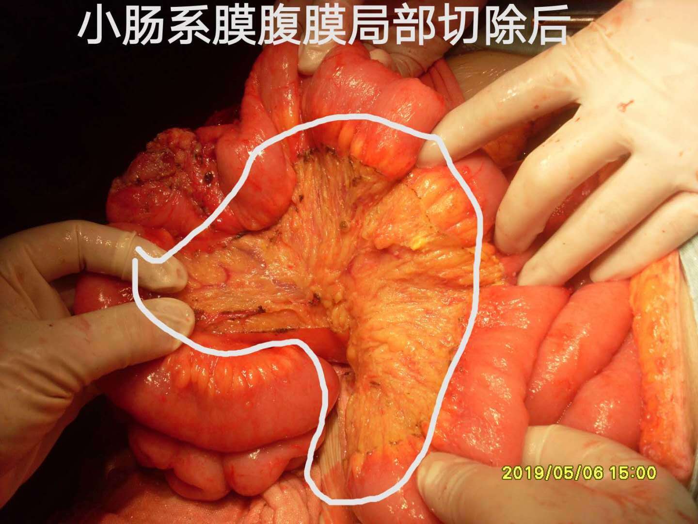 8 实施手术方案:右半结肠,大网膜饼,胃大弯外侧肿物及脾脏切除.