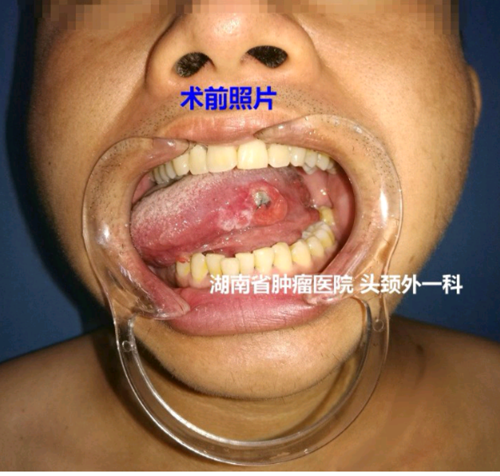 舌癌动完手术图片图片