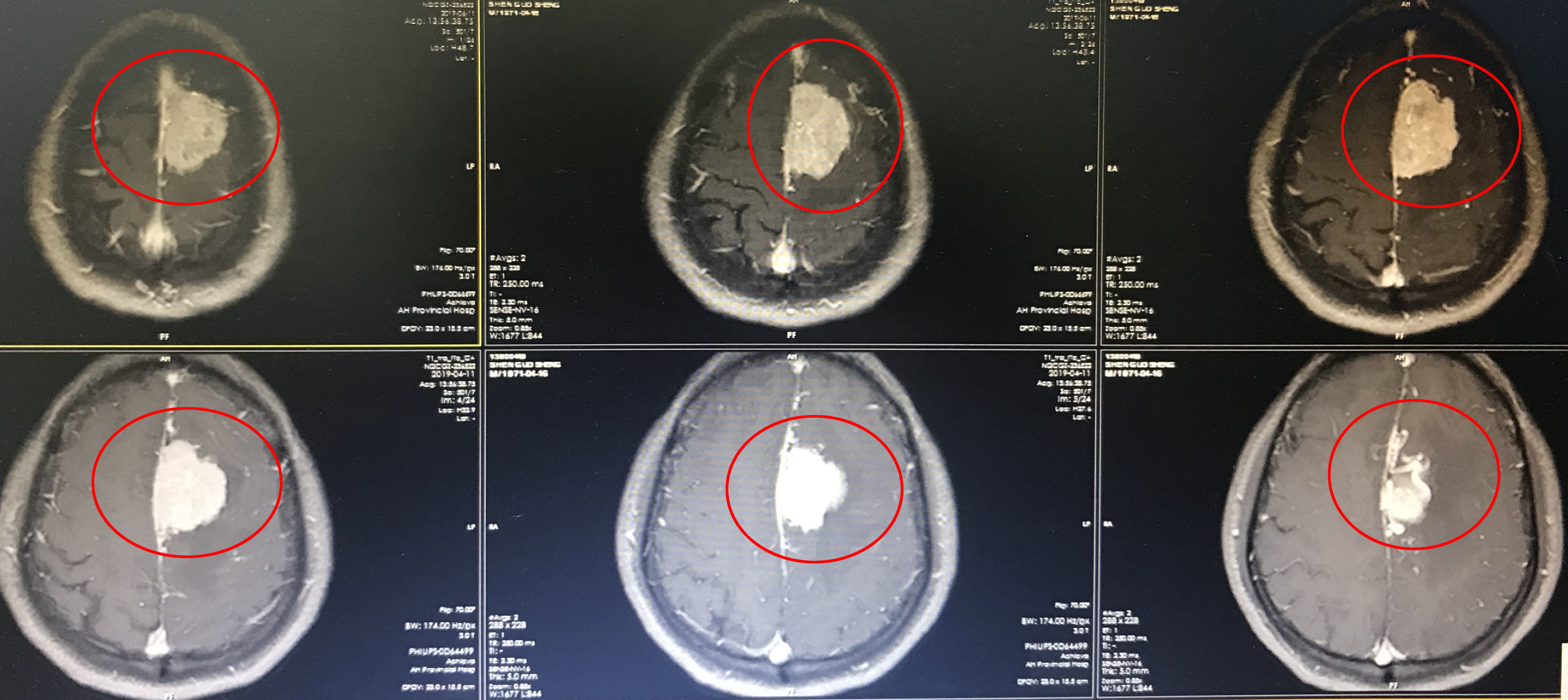 良性脑瘤图片