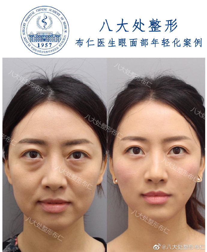 眼部精雕丨完美实现眼周年轻化向衰老sayno