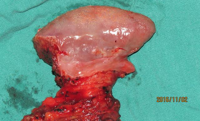 口腔癌有哪些典型症状注意这8个症状避免错过最佳治疗时机