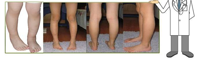 小孩走路内八字怎么治疗