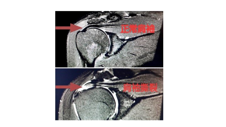 肩部疼痛勿轻视,担心"肩袖撕裂"找上来_肩关节损伤_症状_治疗方法