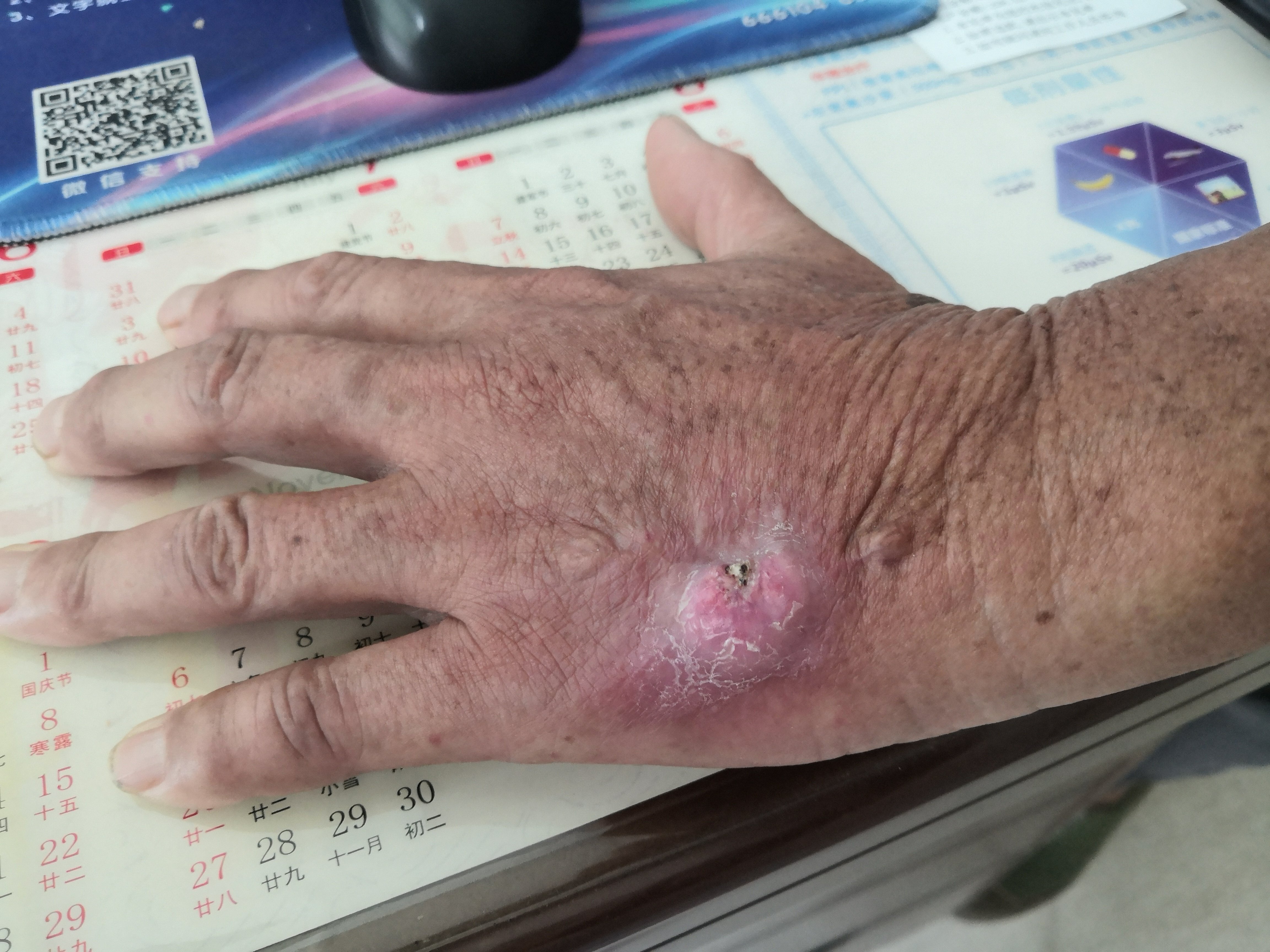 手背皮癌早期表皮图样图片