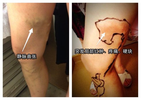 典型病例:下肢静脉曲张突发肿痛——急性血栓性浅静脉炎 - 好大夫在线