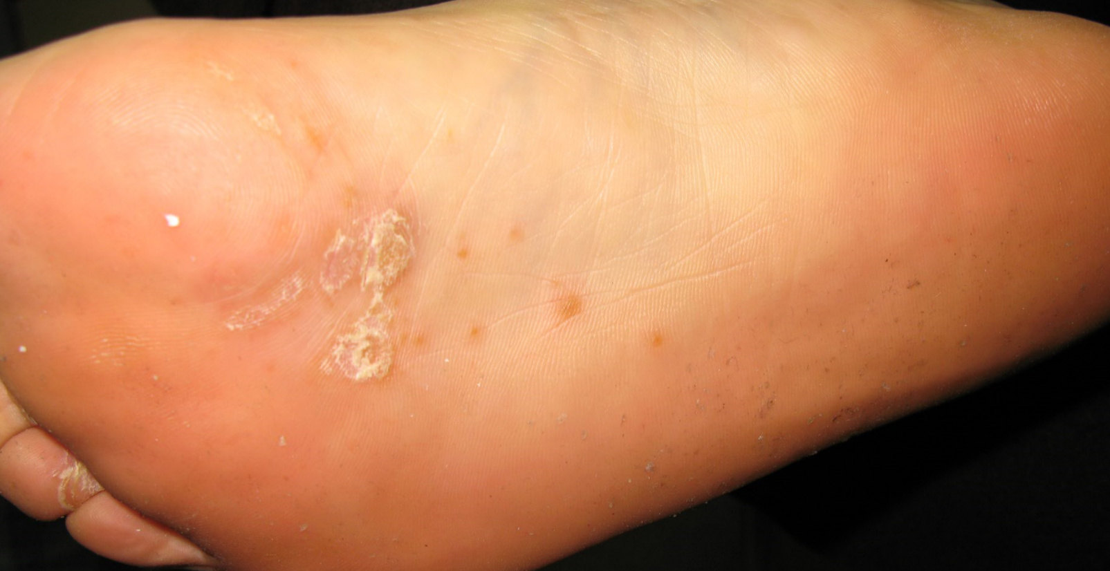 玫瑰糠疹偶然类似梅毒,也会出现在脚底和手掌;有时玫瑰糠疹表现为比较