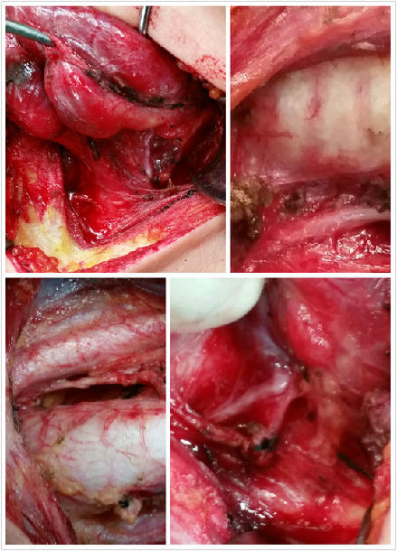 甲状腺手术中喉返神经的探查与保护