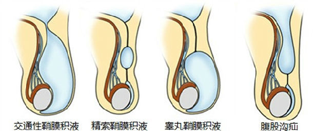 男宝宝的睾丸在生长过程中从肚子里逐渐下降到阴囊底部,这时候一个