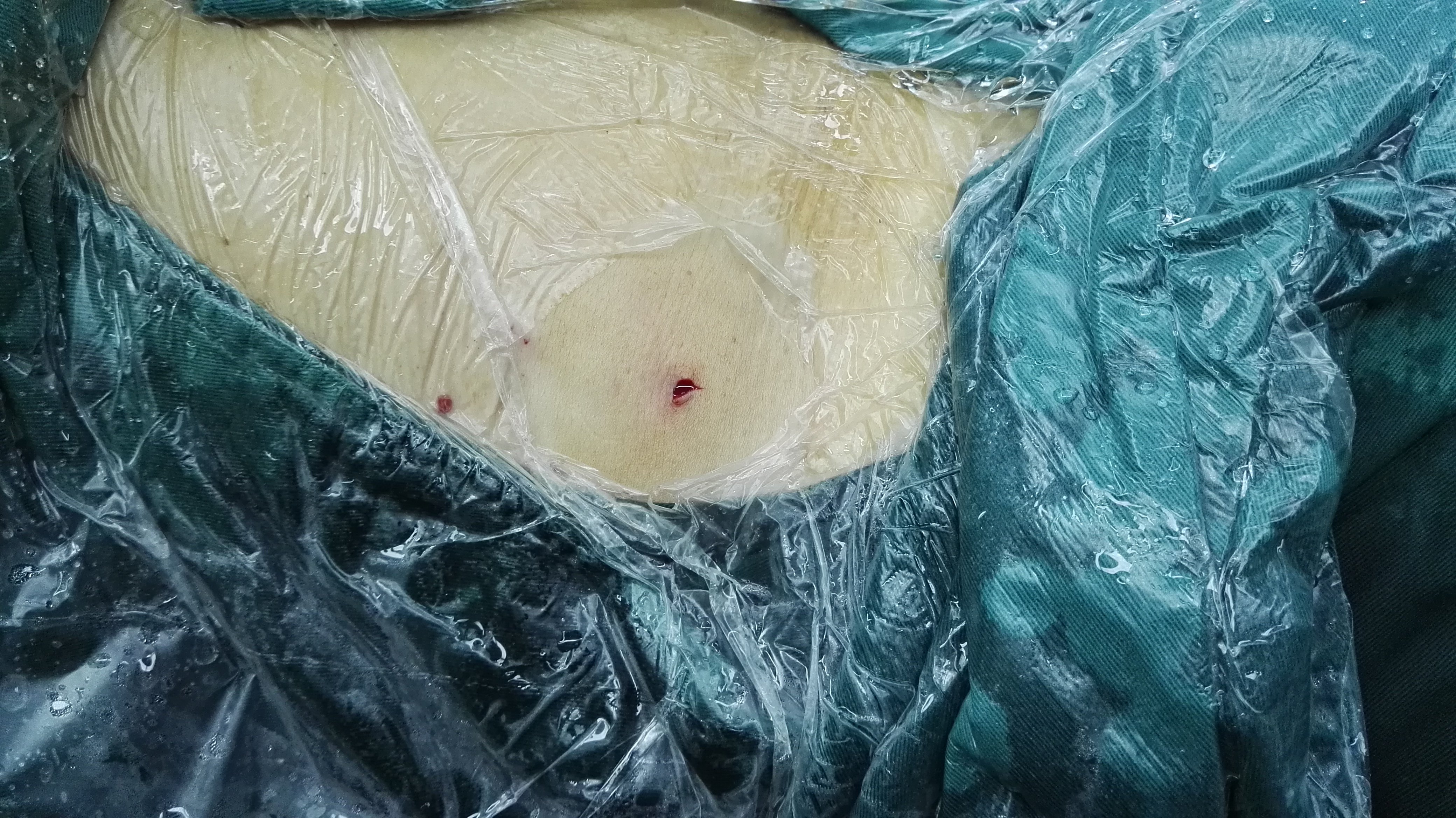 超微通道经皮肾镜手术对小于3厘米的肾结石是