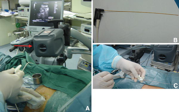 肾结石插管手术图图片