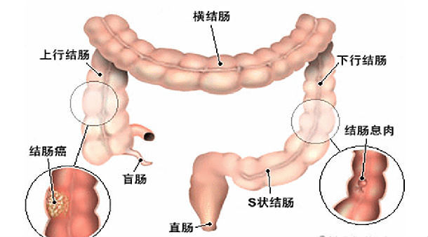 大肠息肉——可以引发癌症的肉疙瘩 