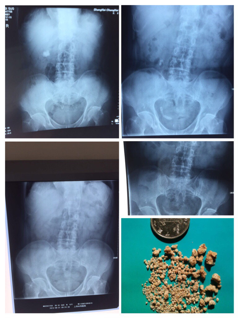泌尿系结石体外震波碎石(体外冲击波碎石)