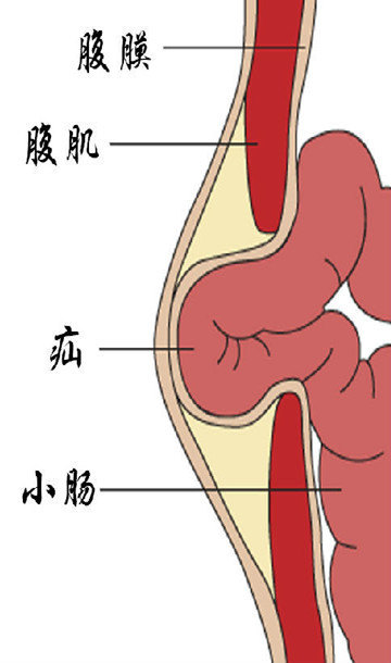 认识成人腹股沟疝和选择合适的治疗方式