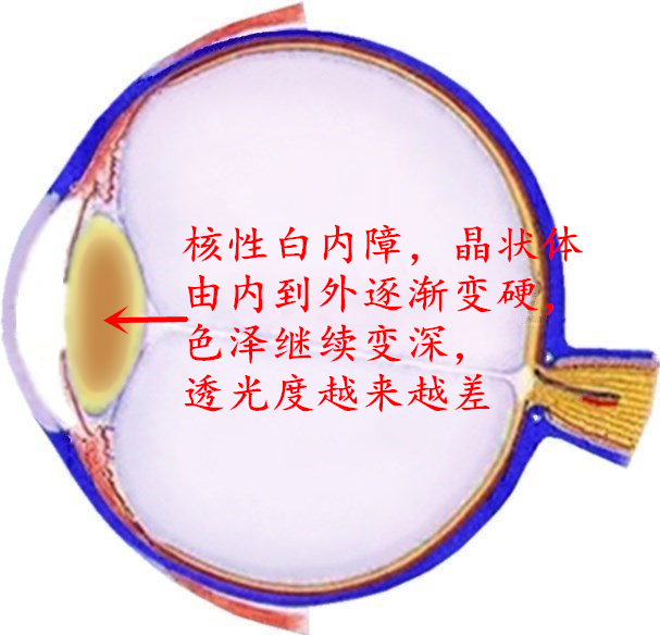 核性白内障也比较多见,由于晶状体前膜的细胞代谢物不断堆积浓缩,到了