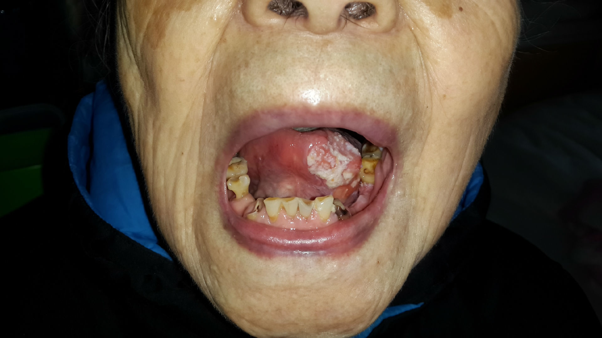 图1 左侧舌侧缘肿瘤图2 右侧舌口底乳头状瘤