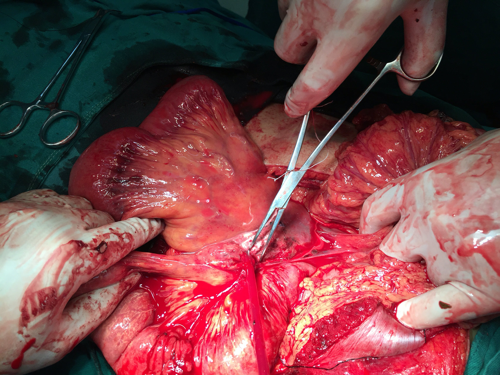 深夜救治车祸腹部损伤肠断裂