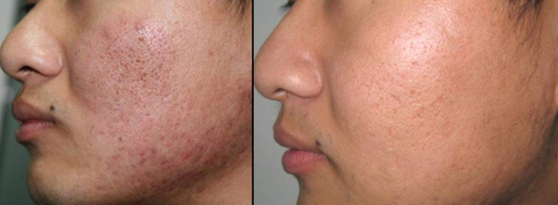 痤疮瘢痕痘坑及手术瘢痕的预防和治疗