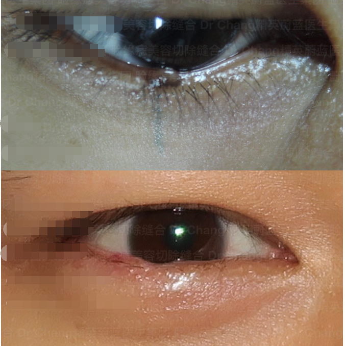 睑缘痣 美容缝合 - 好大夫在线