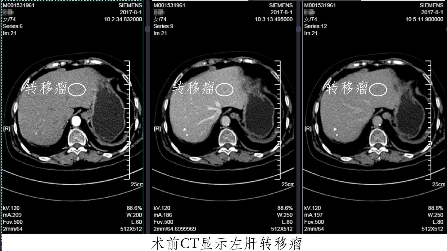 老齡胰腺癌患者伴有肝轉移,能不能一次手術切除?_胰腺癌 - 好大夫在線