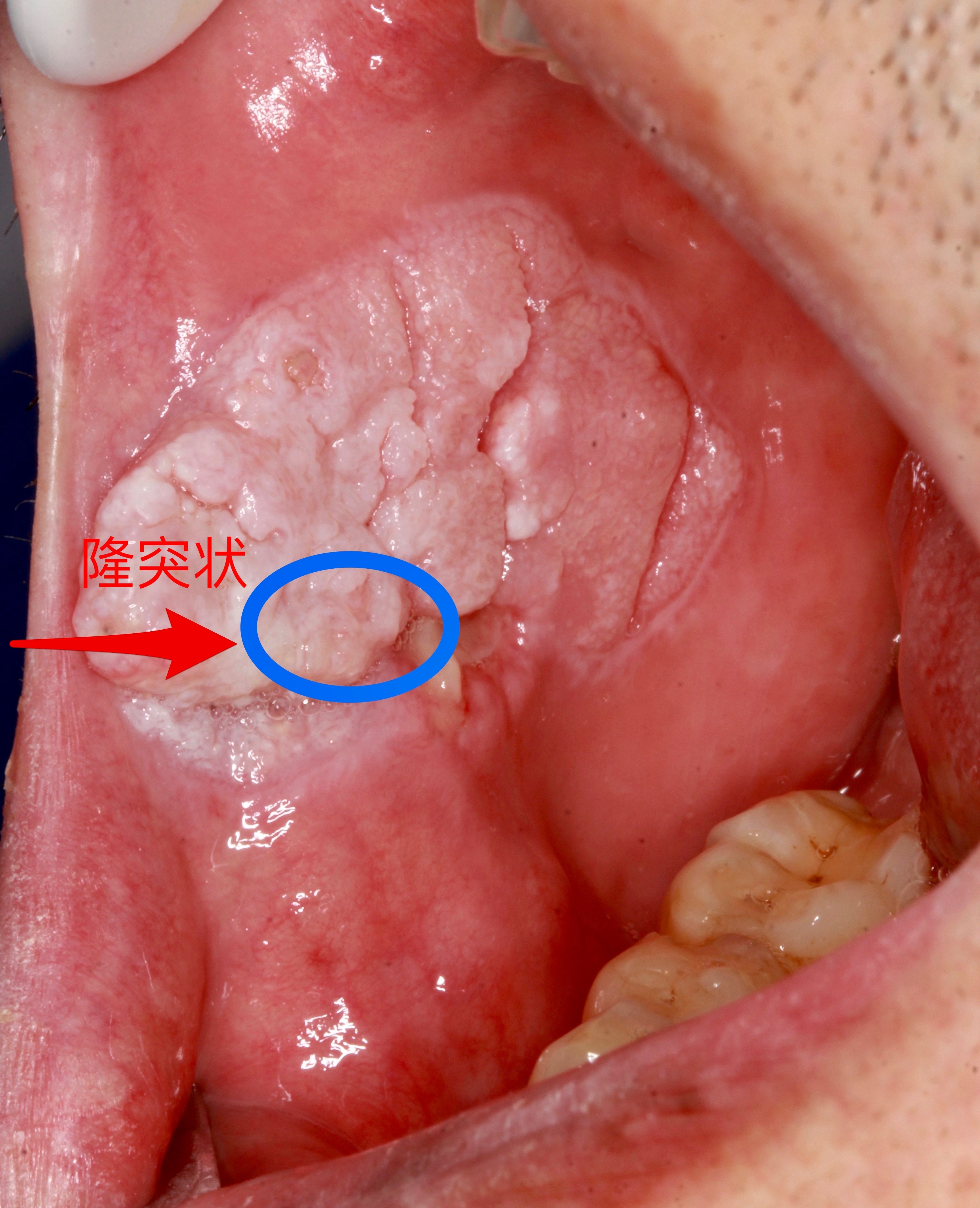 口腔肿瘤早期症状图片图片
