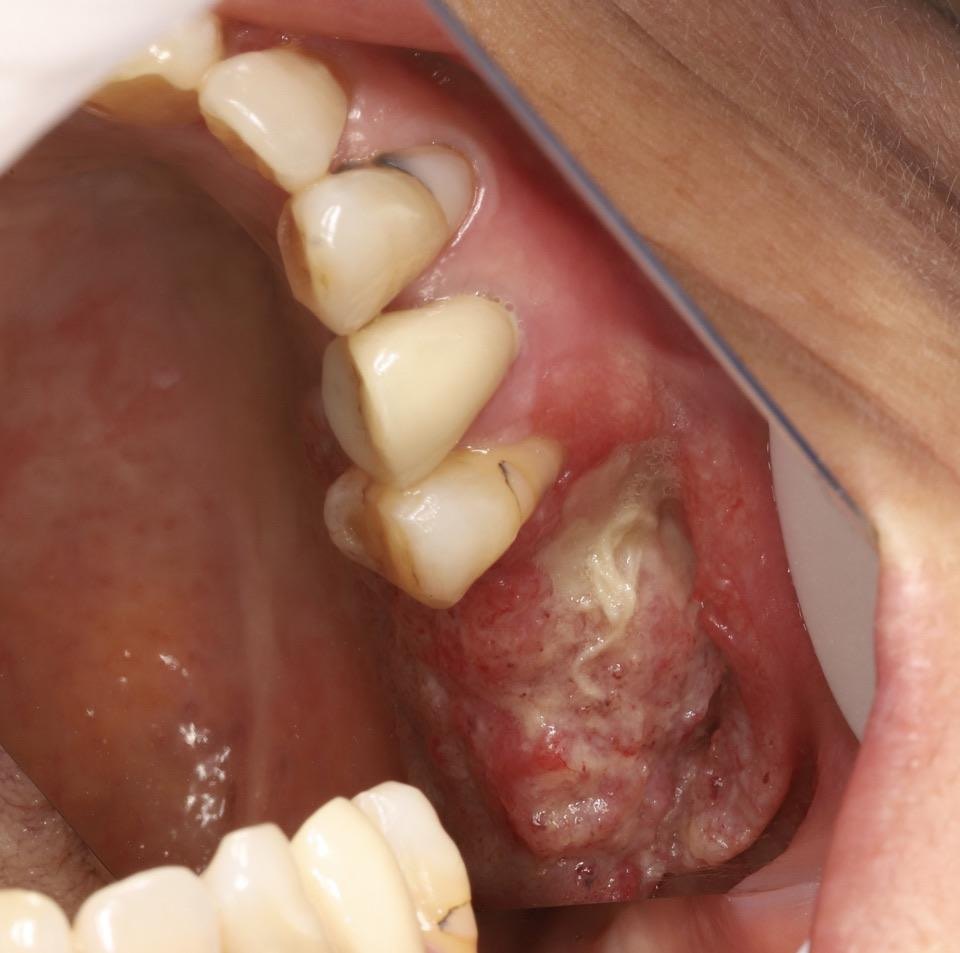 口腔癌早期怎么治疗图片