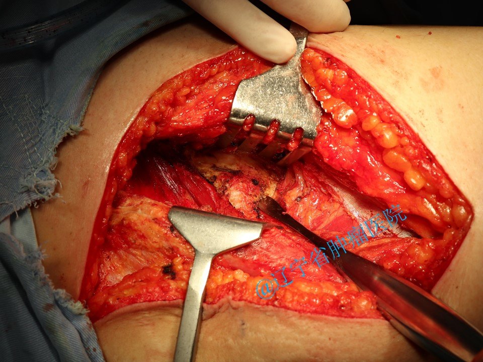 骶管囊肿手术图片