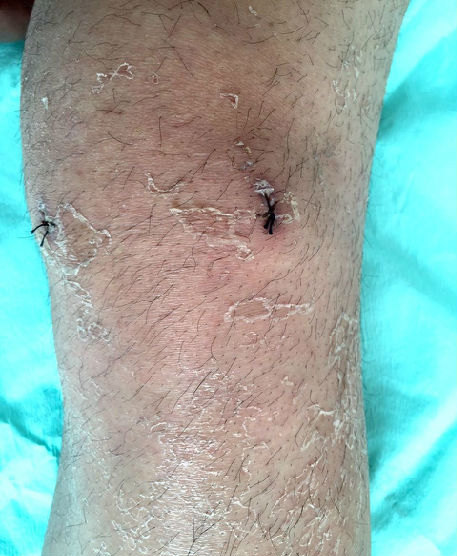 术后常见的几种皮肤反应_皮肤过敏_皮肤过敏介绍 - 好大夫在线