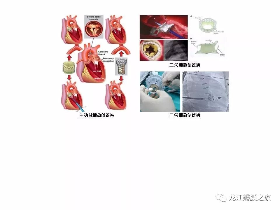 手術無需常規開胸及體外循環,因而創傷小,術後恢復快.