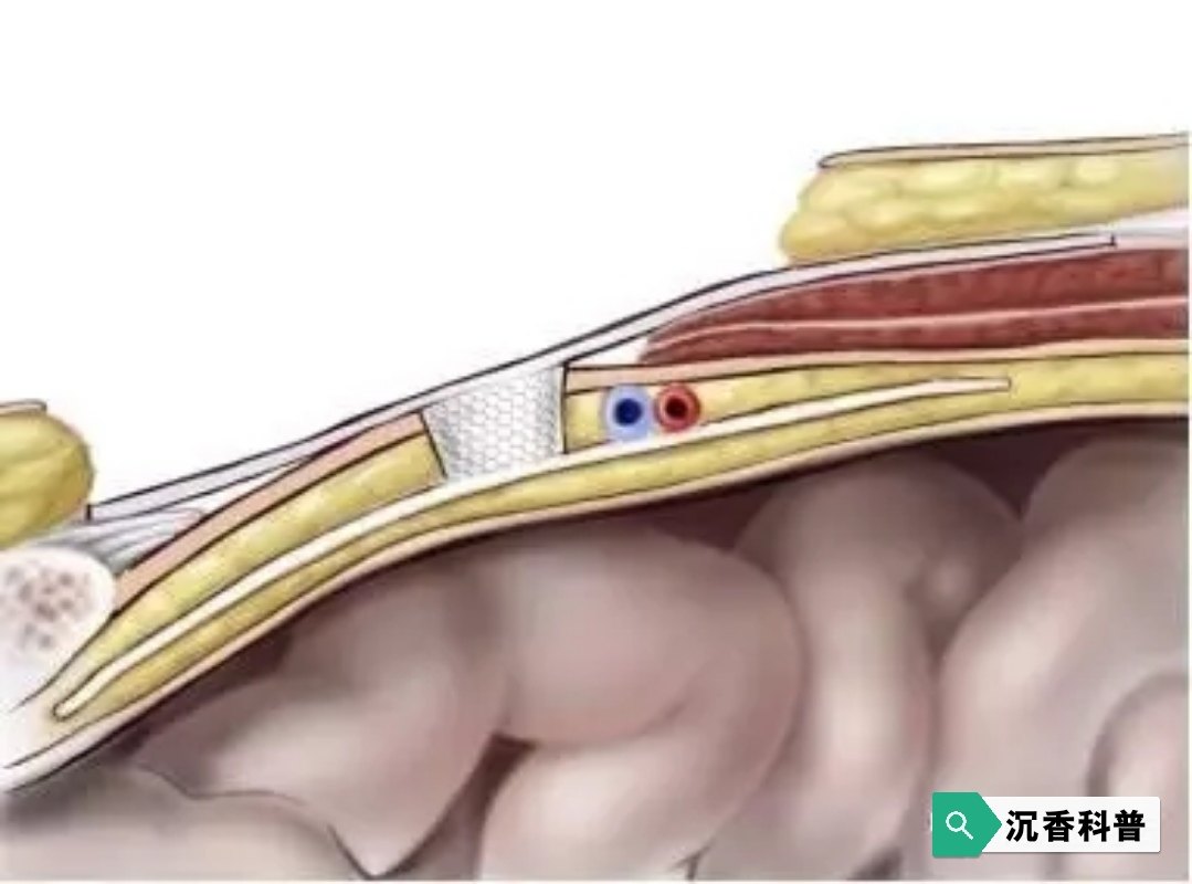 開放腹股溝疝手術的規範化步驟_腹股溝疝_腹股溝疝治療方式 - 好大夫