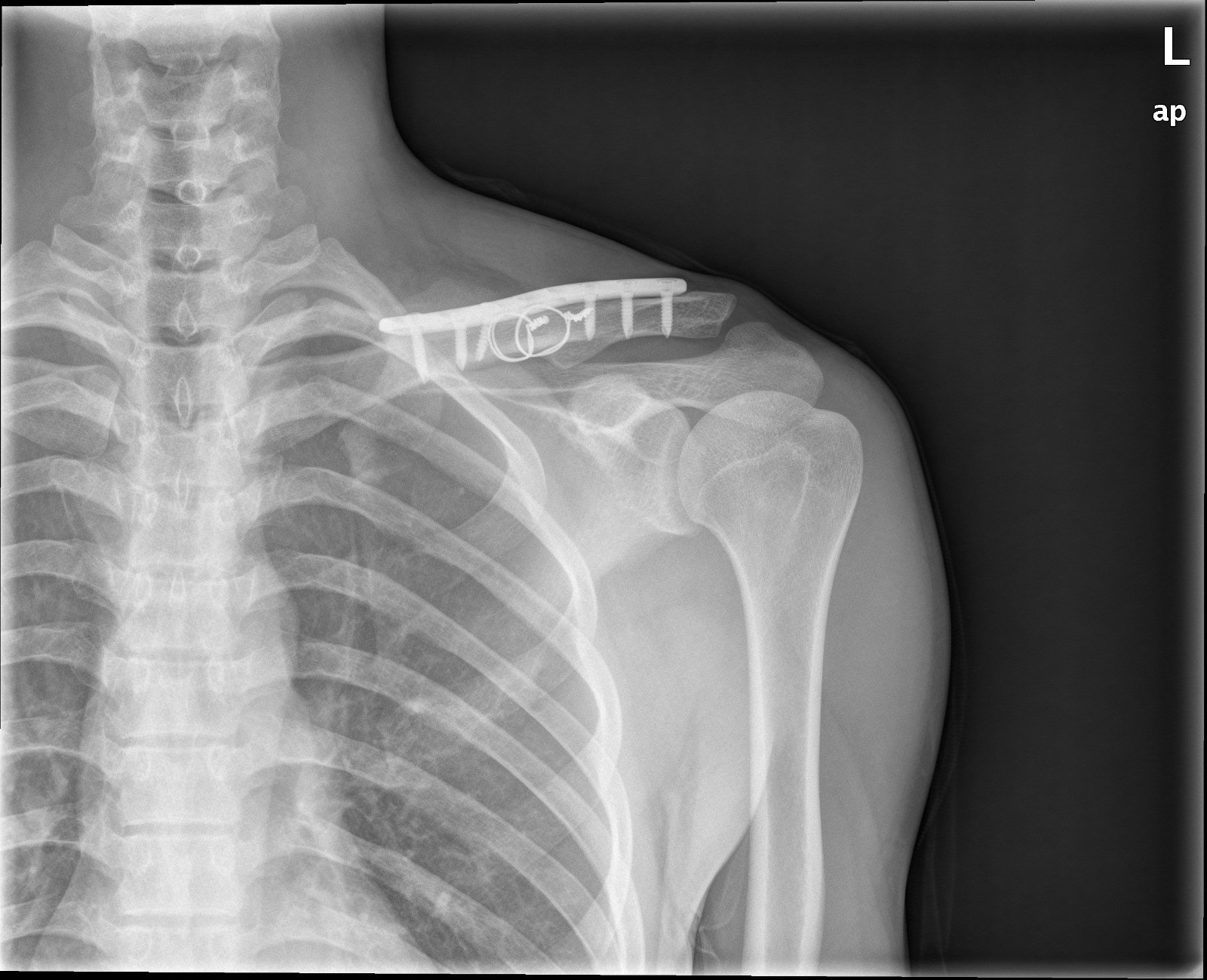 锁骨骨折及肩锁脱位的术后康复 锁骨骨折 锁骨骨折